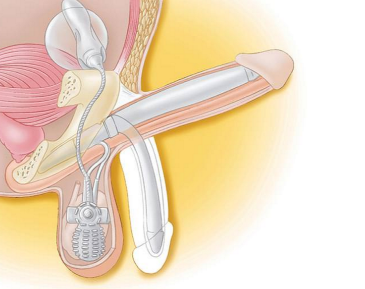  AMS 700™ Penile Implant