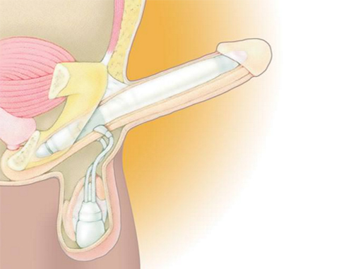 Penile implant illustration.